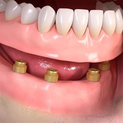 Implant Retained Dentures Graham WA 98338